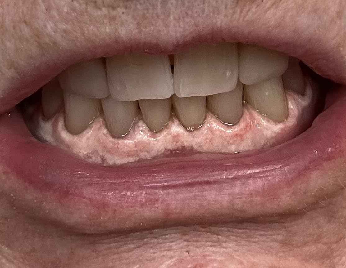 Auraglow Teeth Whitening Kit, LED Accelerator Light, 35% Carbamide Peroxide Teeth Whitening Gel, 20+ Whitening Treatments, Whitens up to 10 Shades in 7 Days customer photo 1