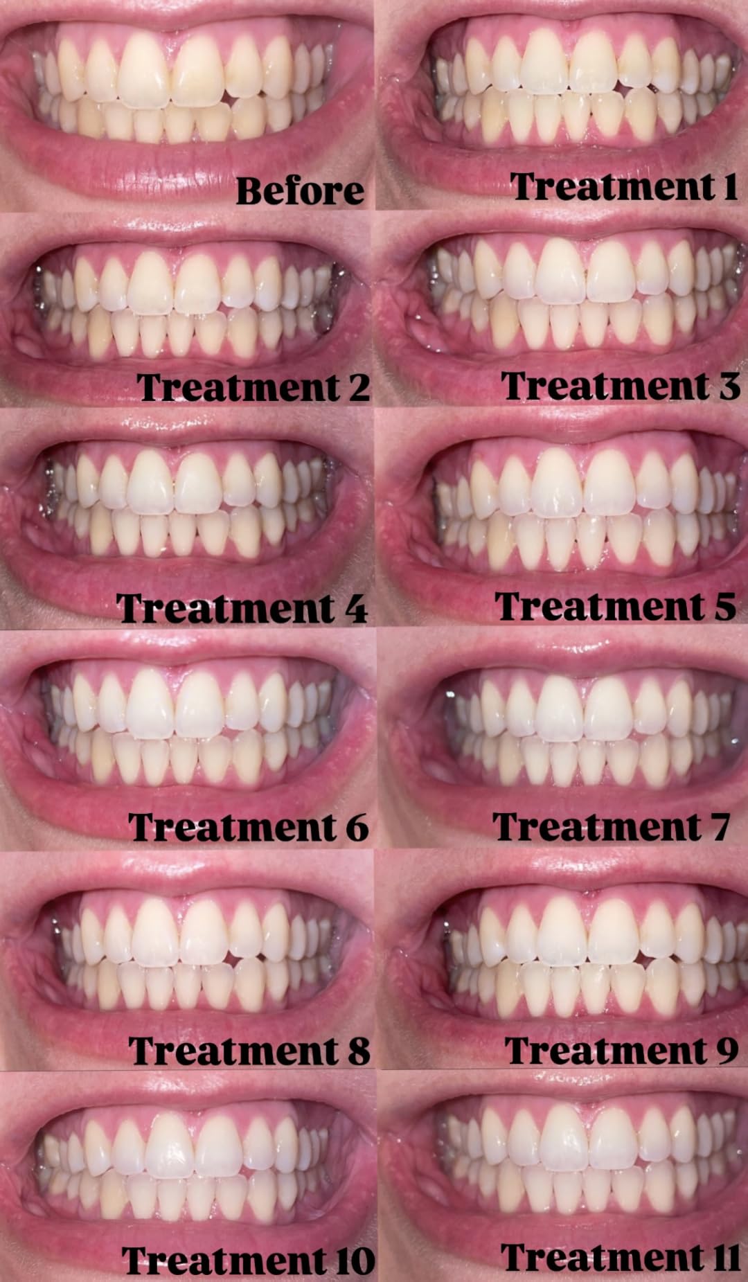Auraglow Teeth Whitening Kit, LED Accelerator Light, 35% Carbamide Peroxide Teeth Whitening Gel, 20+ Whitening Treatments, Whitens up to 10 Shades in 7 Days customer photo 2