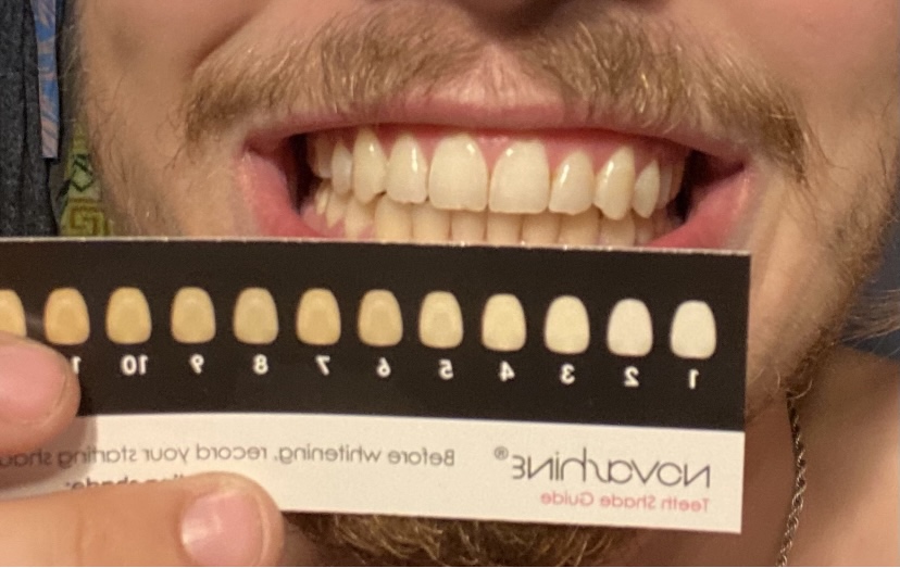 Novashine Professional Teeth Whitening Kit: Advanced Blue LED Light, Concentrated Peroxide Gel, Smartphone Adapter, Travel Bag customer photo 1