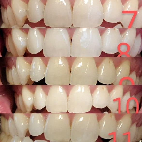 MySmile Teeth Whitening LED Light w/Mouth Tray Home Oral Whitening Device | Blue LED Boosts Teeth Whitening with 4ML Gel Capsule. Gentle on Teeth, Non-Sensitive, Portable for Home and Travel. customer photo 1