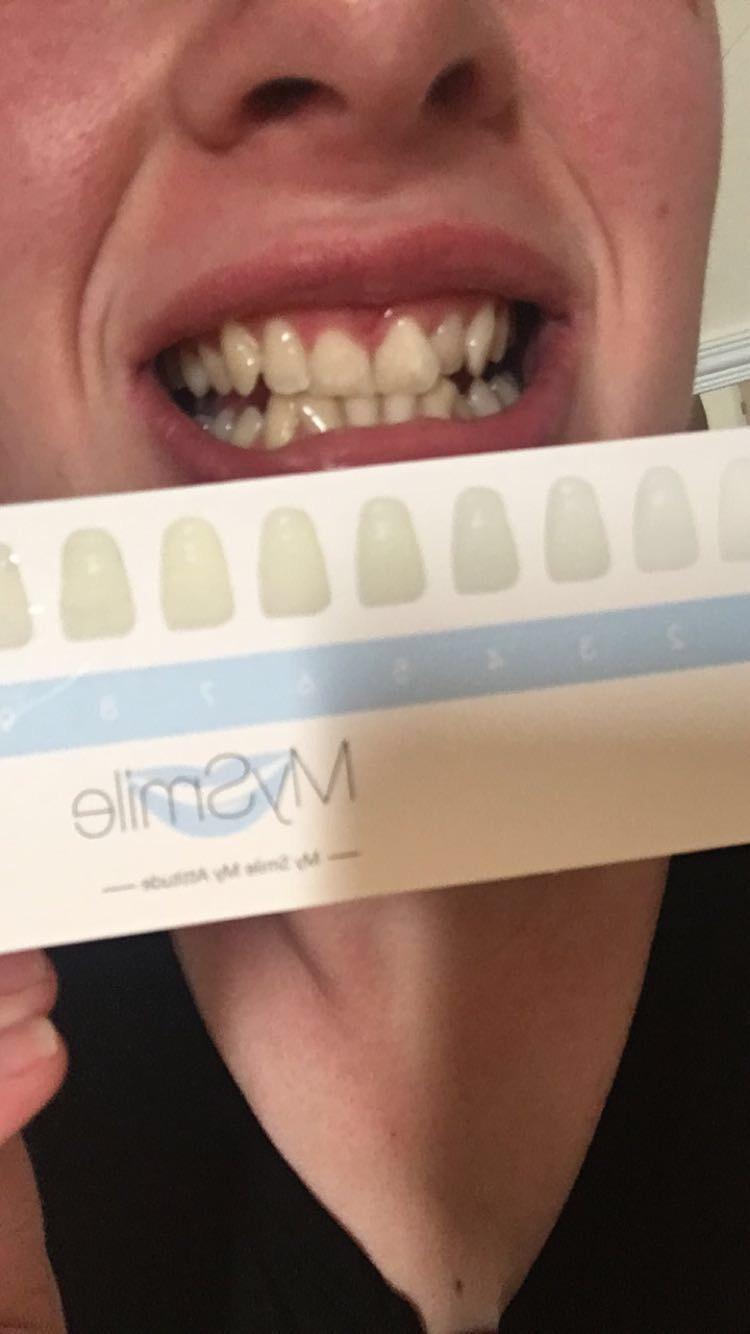 MySmile Teeth Whitening LED Light w/Mouth Tray Home Oral Whitening Device | Blue LED Boosts Teeth Whitening with 4ML Gel Capsule. Gentle on Teeth, Non-Sensitive, Portable for Home and Travel. customer photo 2