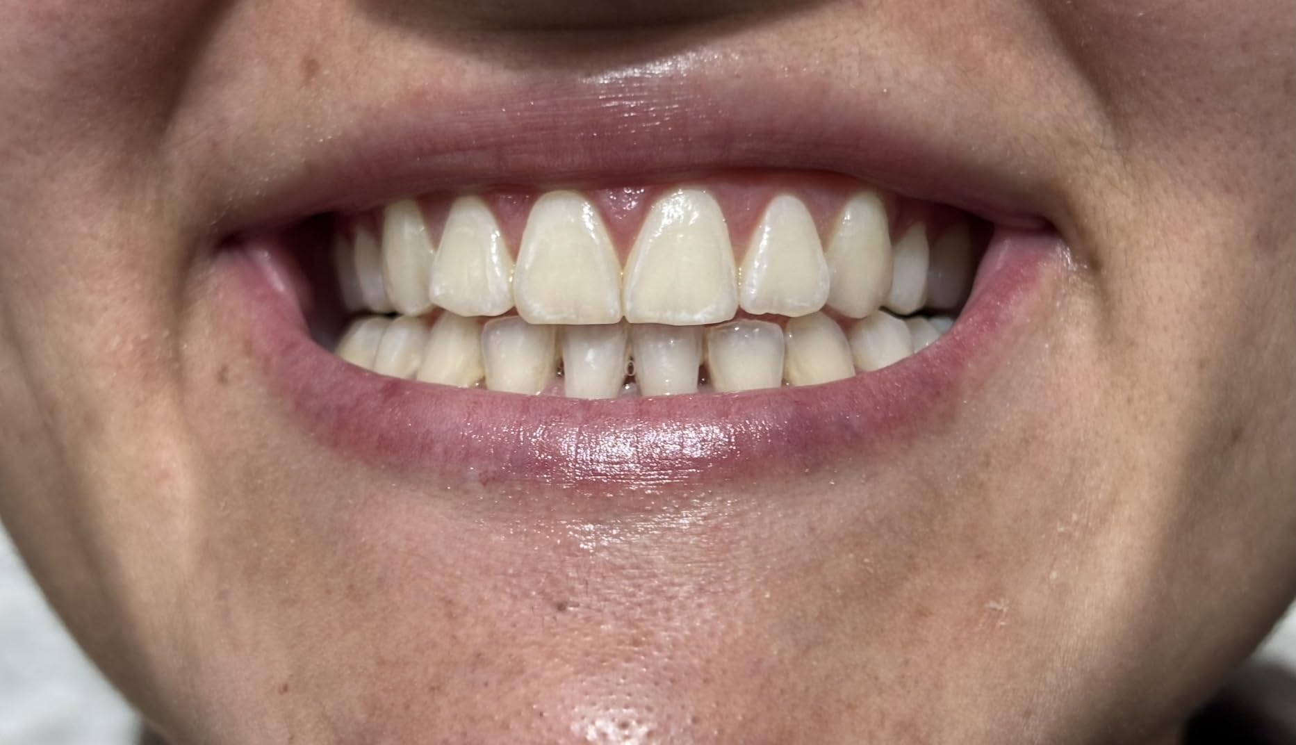 Crest 3DWhitestrips Sensitive White At-Home Teeth Whitening Kit, 18 Treatments, Gently Removes 15 Years of Stains customer photo 2