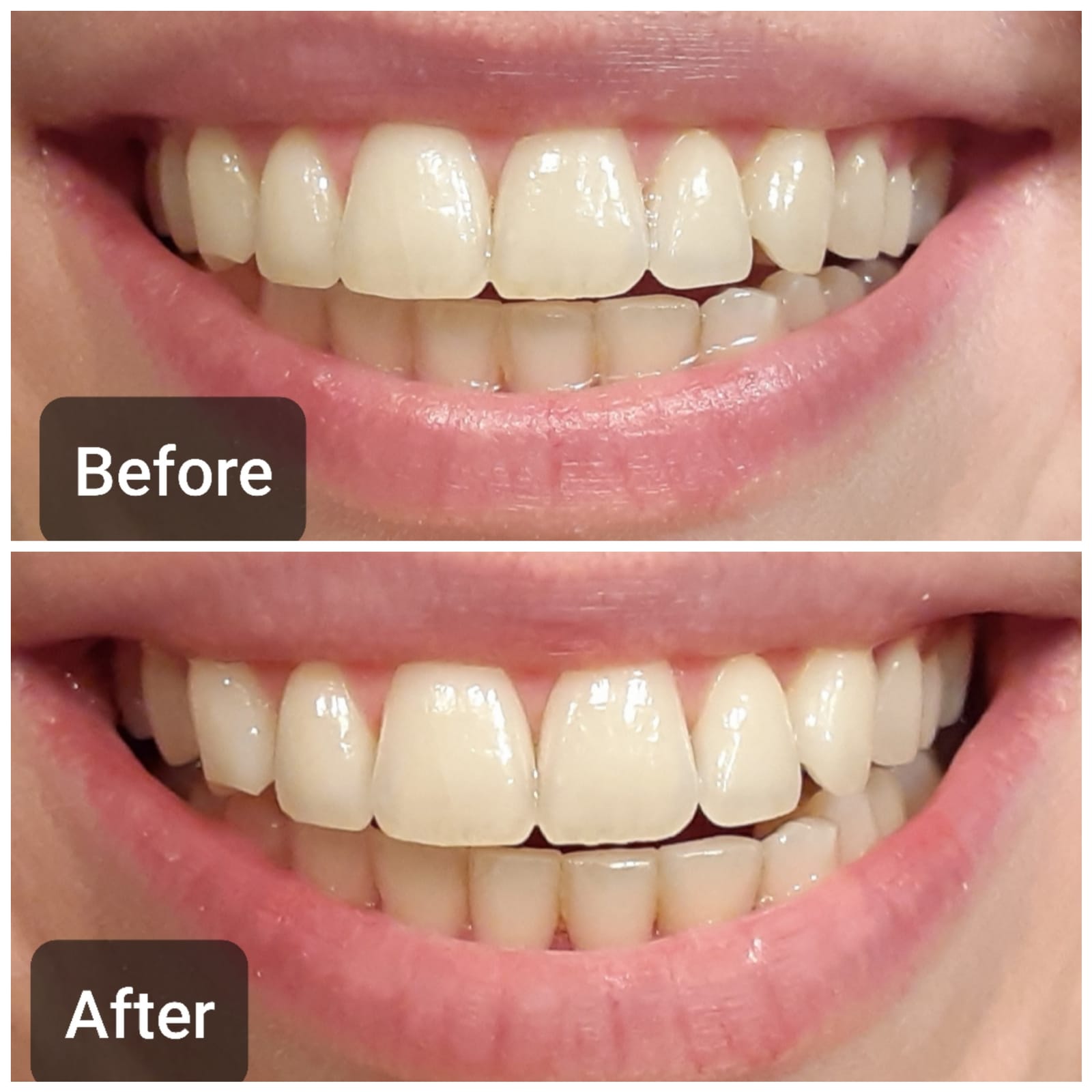 Auraglow Plug-in LED Teeth Whitening Kit - Wired Light Device - 35% Carbamide Peroxide Gel - 12 Treatments - at-Home Tooth Whitening System - Enamel-Safe at-Home Whitening for Coffee & Tea Stains customer photo 2